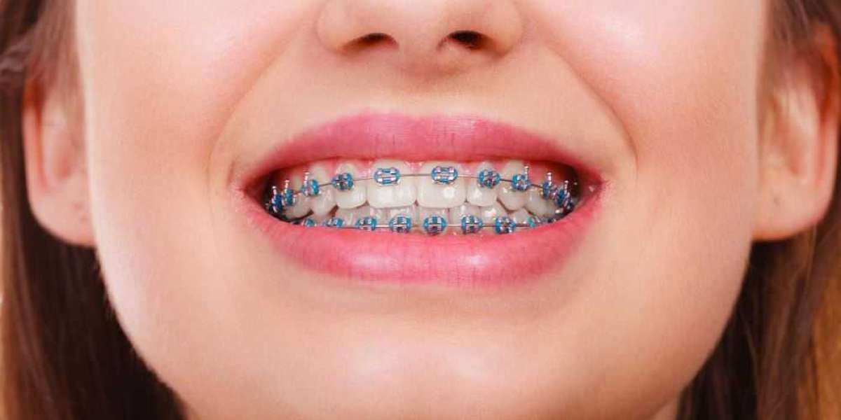 Benefits of Adult Orthodontics with Braces