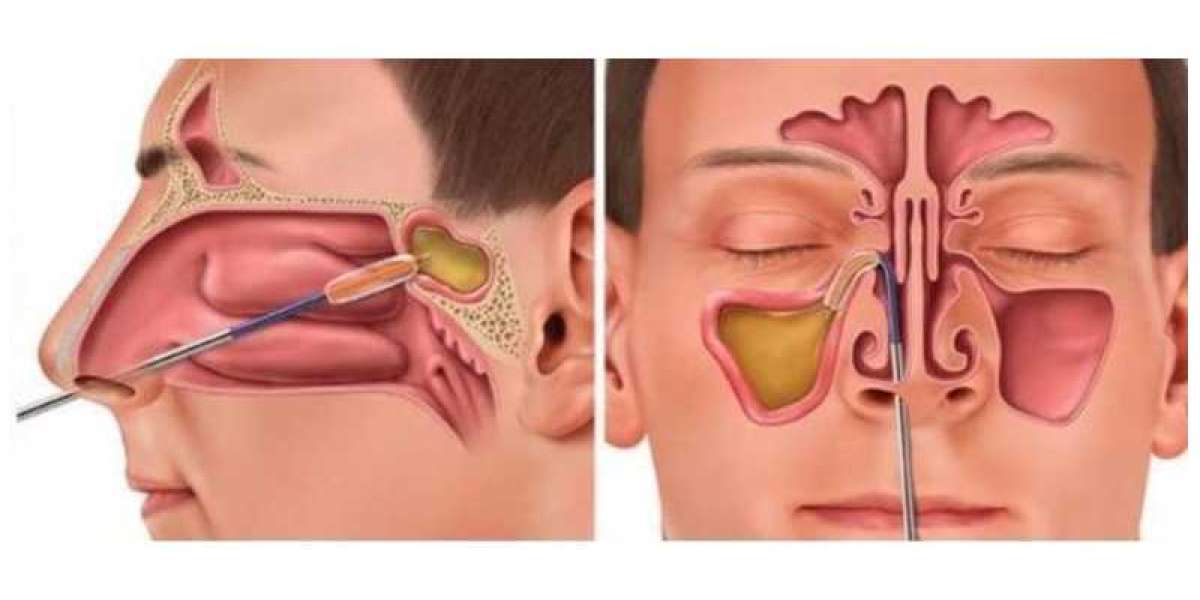 Balloon Sinuplasty: A Minimally Invasive Option for Chronic Sinusitis