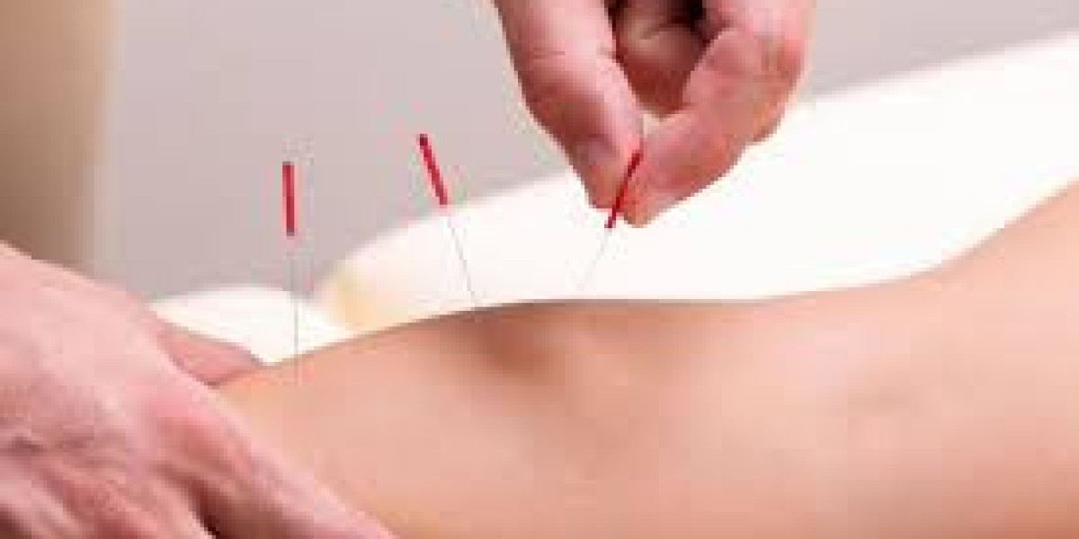 Can Acupuncture Improve Focus & Reduce Stress in Athletes?