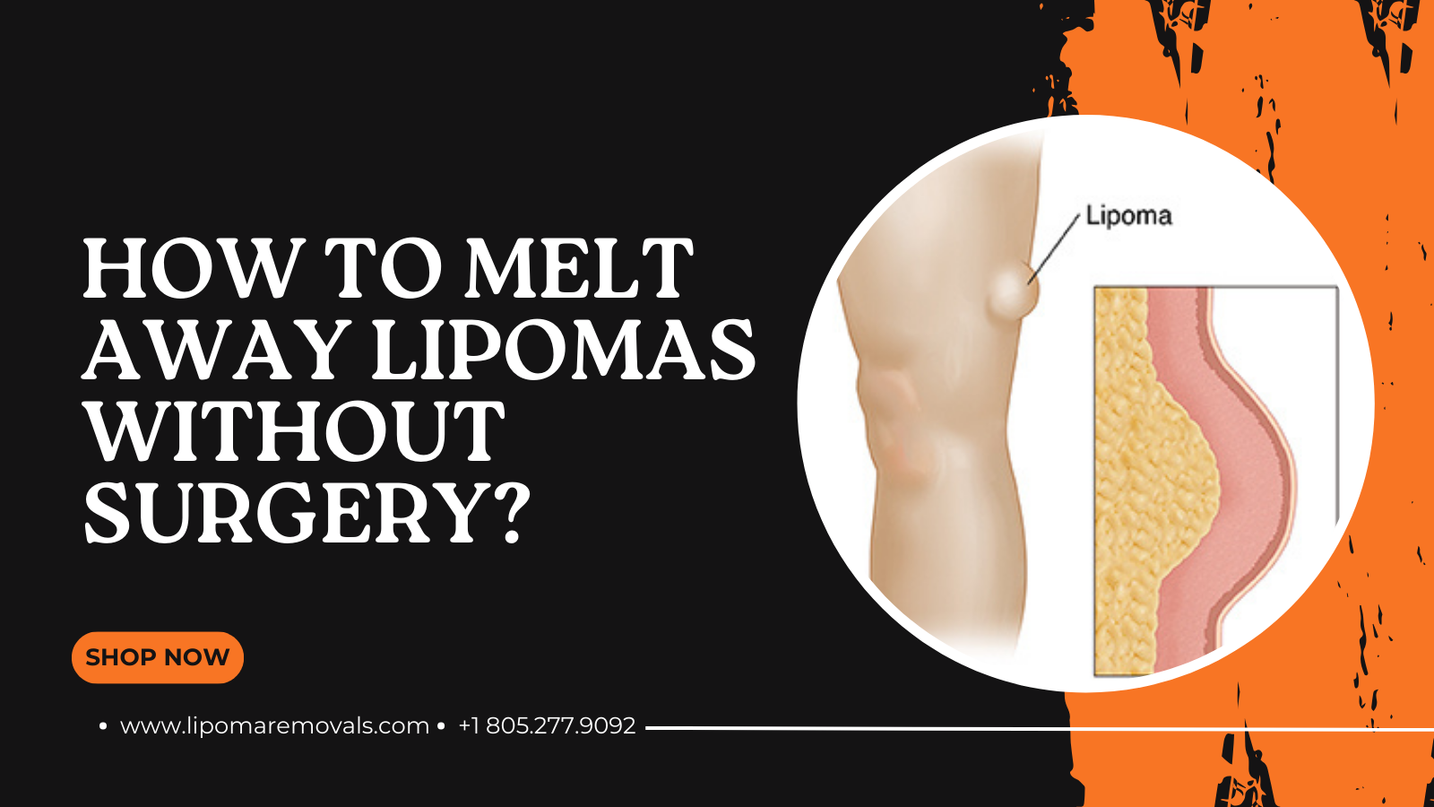 How To Melt Away Lipomas Without Surgery?