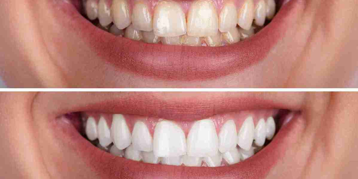 Can Whitened Teeth Enhance Appearance by Masking Flaws?